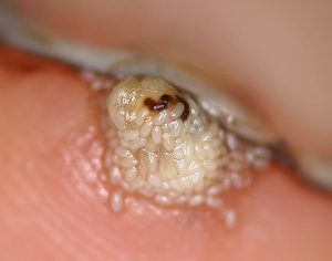 Sand Flea Control Johannesburg can help prevent secondary infection and diseases caused by Fleas and other biting insects found here in Gauteng